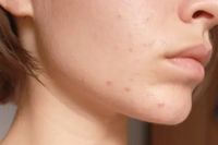 probiotique acné